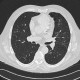 Alveolar hemorrhage, ANCA vasculitis, paraseptal emphysema, follow-up: CT - Computed tomography